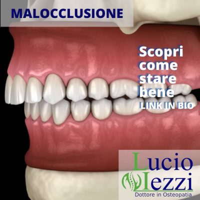 Malocclusione